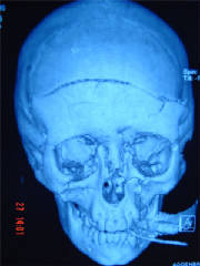 front-view-showing-fracture